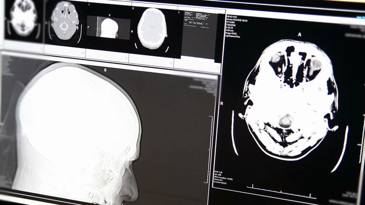 Durchbruch in der Alzheimer-Therapie: EU lässt Wirkstoff zu