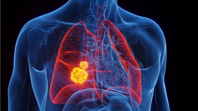 Neue Kassenleistung kann ab April Zehntausende Krebs-Todesfälle verhindern