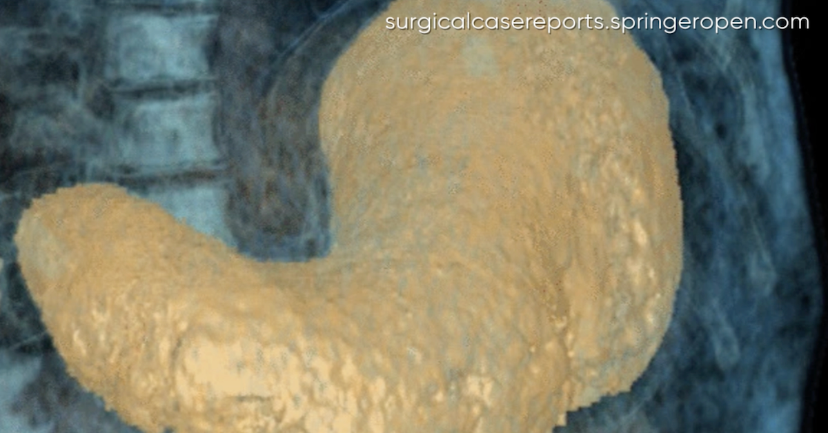 Eklig: Mädchen hatte riesigen Haarball im Bauch